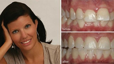 Before and After Photo