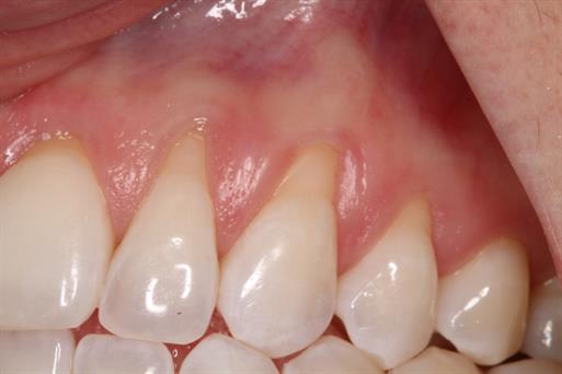 Soft Tissue Grafting Before